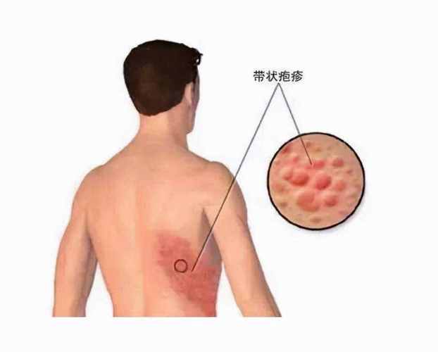 带状疱疹增加心肌梗塞发作风险